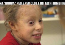 Le Iene, ittiosi malattia della pelle dei bambini arcobaleno: la storia di Cloe | Video Mediaset Le Iene, ittiosi malattia della pelle dei bambini arcobaleno