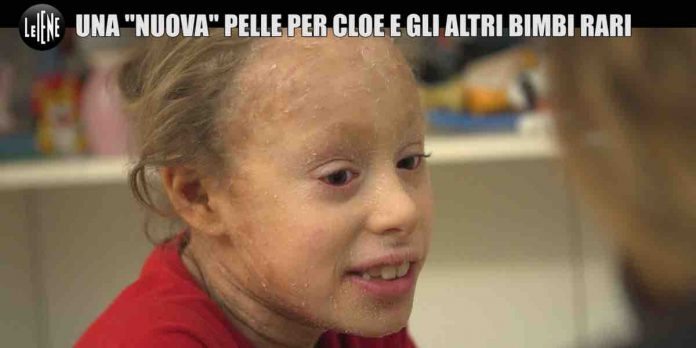 Le Iene, ittiosi malattia della pelle dei bambini arcobaleno: la storia di Cloe | Video Mediaset Le Iene, ittiosi malattia della pelle dei bambini arcobaleno