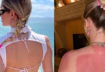 Chiara Ferragni vittima di una scottatura: ecco cosa è accaduto Chiara Ferragni vittima di una scottatura ecco cosa è accaduto
